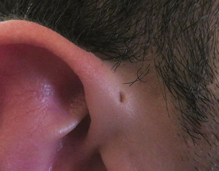 Nhận biết căn bệnh là xuất hiện một lỗ nhỏ phía trên vành tai