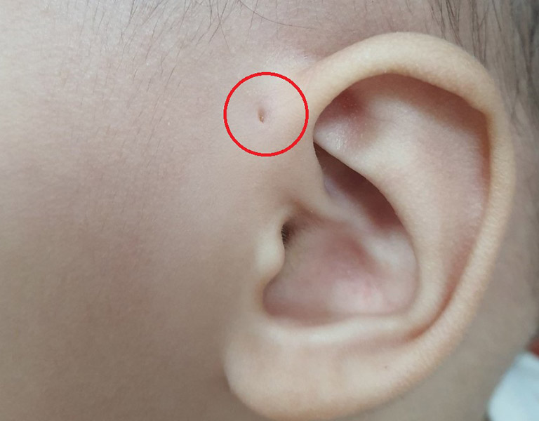 Dấu hiệu nhận biết bệnh rò luân nhĩ ở trẻ là có một lỗ rò hình bằng đầu tăm gần vành tai