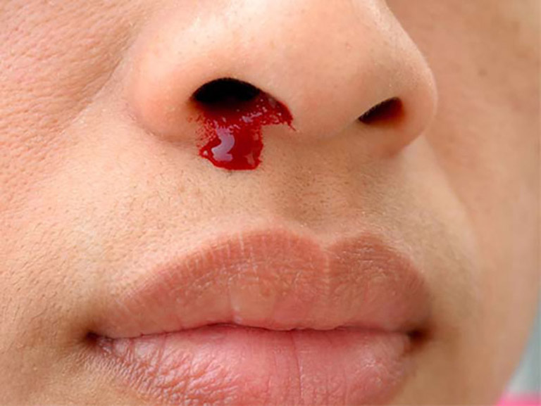 Triệu chứng điển hình của ung thư mũi là chảy máu cam