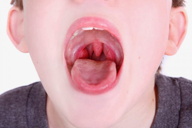 Viêm amidan cấp ở trẻ em là bệnh lý khá phổ biến