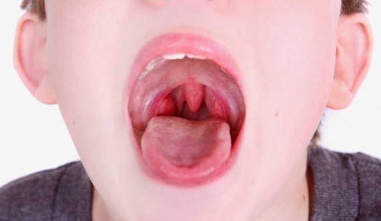 Trẻ bị viêm amidan có gây nguy hiểm cho trẻ nhỏ