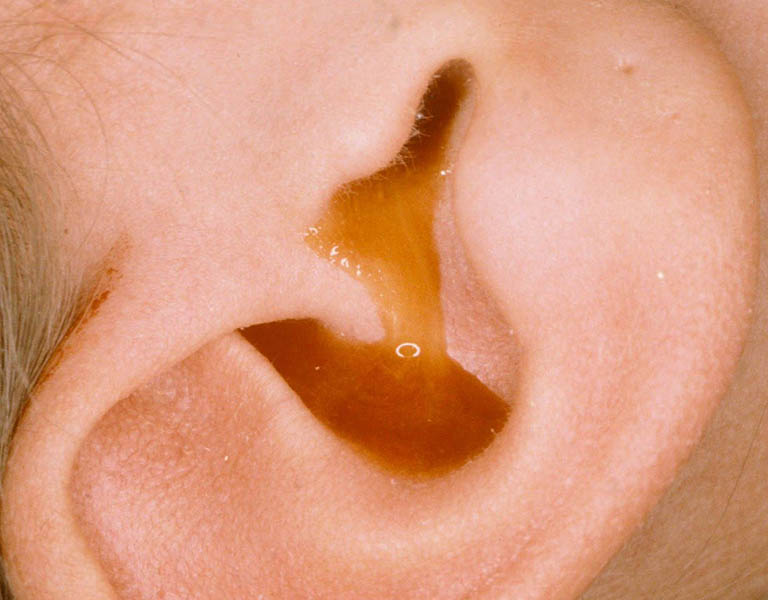 Viêm tai giữa có mủ là tình trạng nhiễm trùng ống tai có kèm chảy mủ