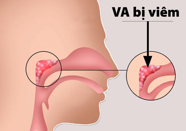 Viêm VA cấp là hiện tượng viêm nhiễm cấp tính do các mô lympho trong vòm họng bị tổn thương