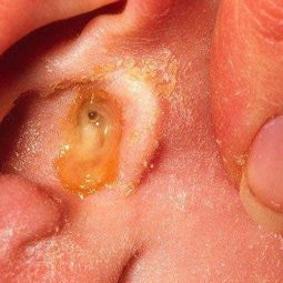 Khi bị nhiễm trùng tai, người bệnh sẽ thấy xuất hiện dịch mủ