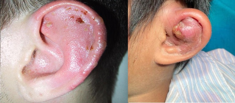 Viêm sụn vành tai là một dạng nhiễm trùng phần loa tai