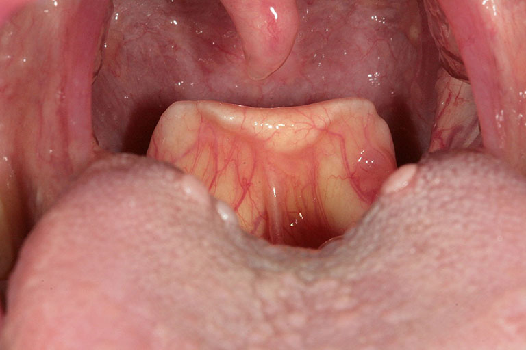 Viêm họng cấp do viêm nhiễm ở niêm mạc họng