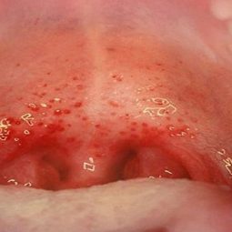 Viêm họng liên cầu khuẩn: Nguyên nhân, cách điều trị và phòng tránh bệnh hiệu quả