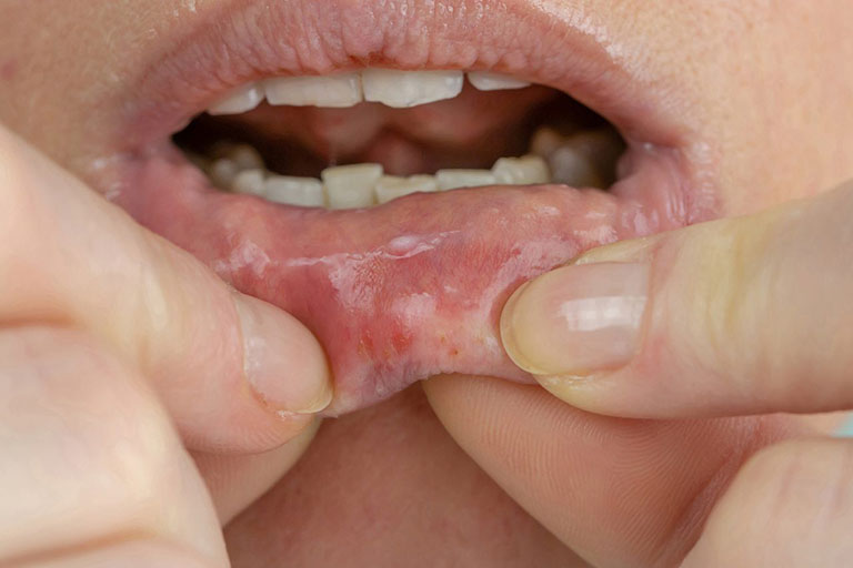 Bệnh ở miệng có thể gây viêm vòm họng