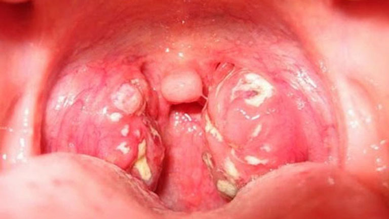 Viêm họng hạt có mủ là thể bệnh phổ biến của bệnh viêm họng mãn tính ở mức độ nặng