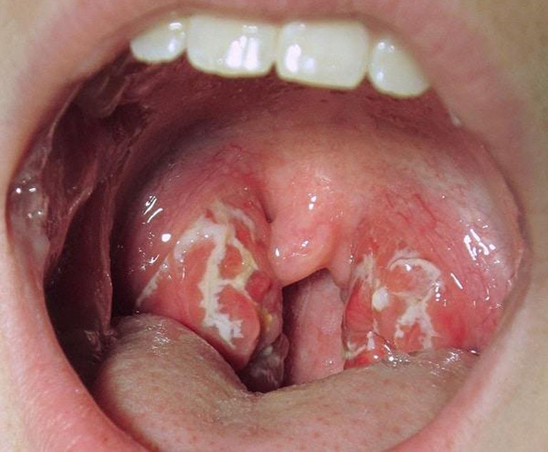 Bệnh viêm họng trắng do nhiều nguyên nhân khác nhau gây ra