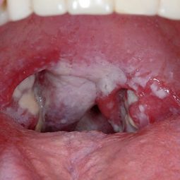 Viêm họng trắng: Thông tin về nguyên nhân, triệu chứng và cách điều trị hiệu quả