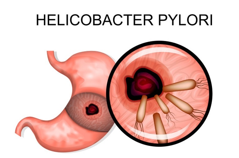 Vi khuẩn HP có tên tiếng Anh là Helicobacter Pylori