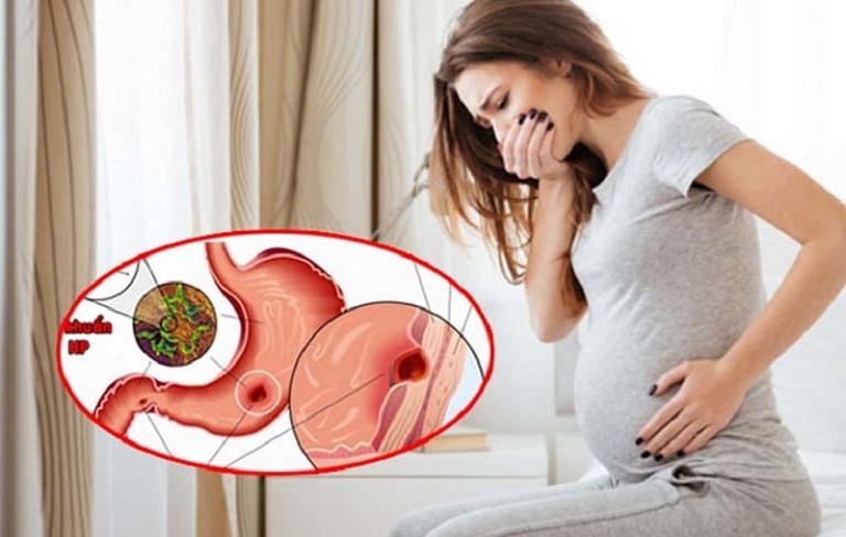 Phụ nữ mang thai là nhóm đối tượng rất dễ bị trào ngược dạ dày