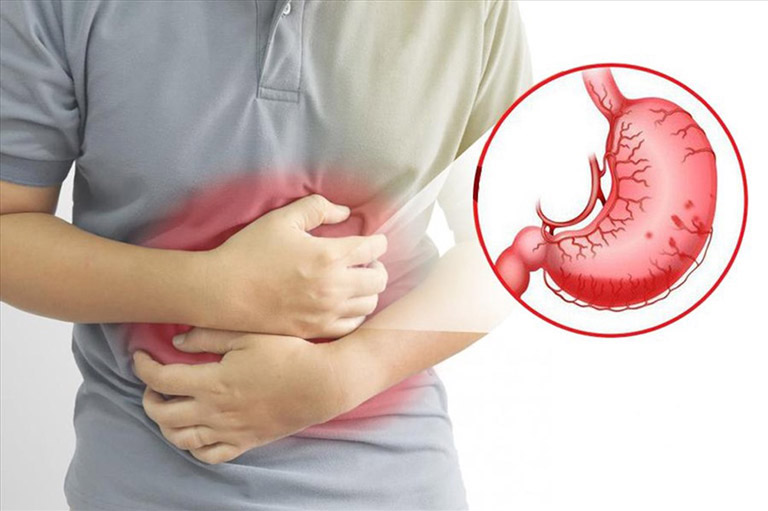 Đau bụng vùng thượng vị là triệu chứng phổ biến nhất ở người bệnh