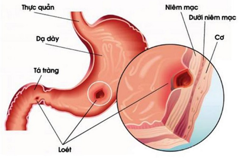 Viêm loét dạ dày tá tràng là tình trạng niêm mạc dạ dày bị tổn thương