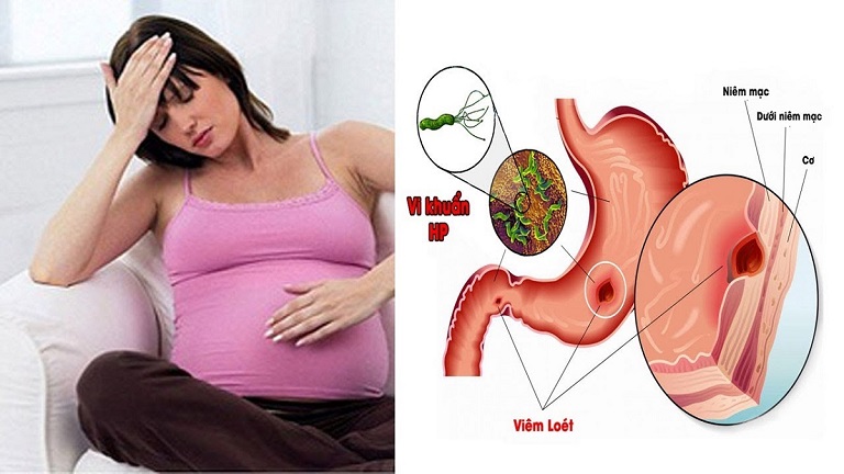 Có nhiều nguyên nhân dẫn đến tình trạng xuất huyết dạ dày khi mang thai